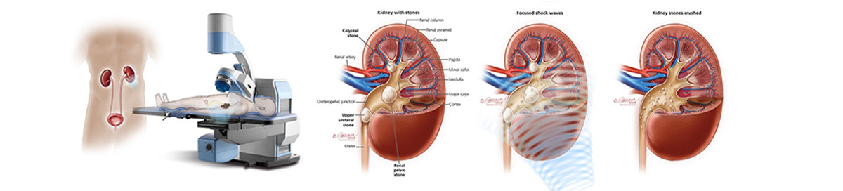 Urológica-intervenção-pedra-renal