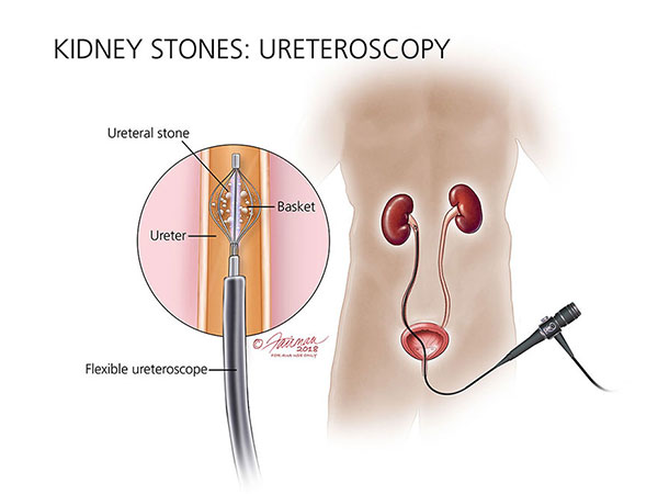 Urológica-intervenção-pedra-renal1
